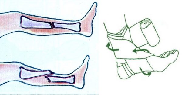 Kırık ve Kırık Çeşitlerinde İlk Yardım